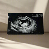 Ultrasound image of a fetus on a black card with a white background